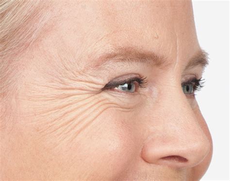 anti wrinkle injections for crow s feet — elanamie clinic