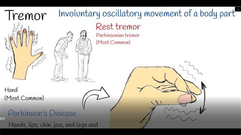 Tremor Shaking Hands Hand Tremors Causes And Treatment Parkinson Or Physiological Tremor