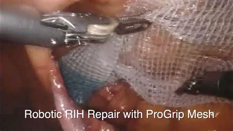 Davinci Robotic Right Inguinal Hernia Repair With Progrip Mesh Youtube