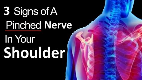 Pinched Nerve In Shoulder Symptoms Causes And Effective Treatments