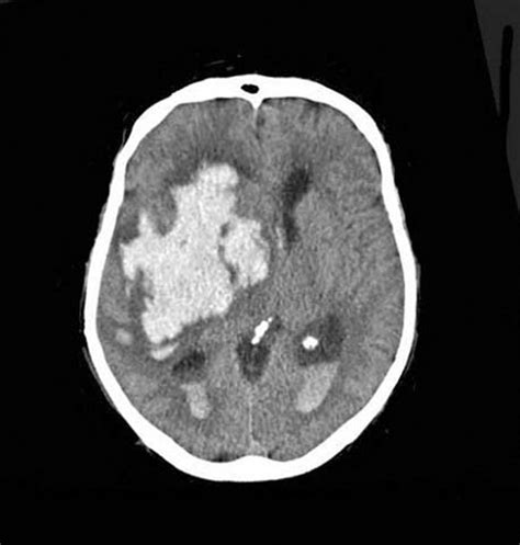 Clinical Review Critical Care Management Of Spontaneous Intracerebral