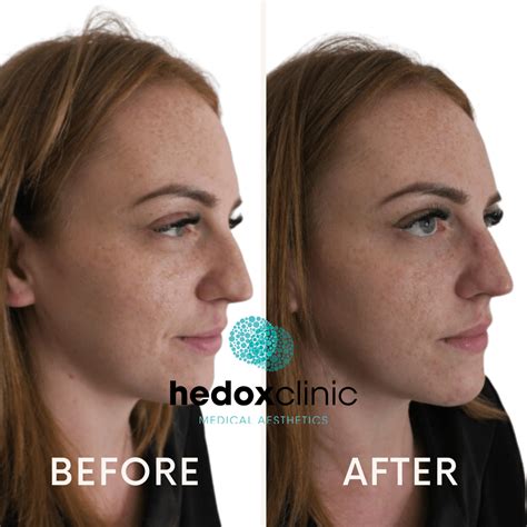 Uneven Misshapen Nose Treatment London Nasal Bridge Tip Filler Hedox Clinic