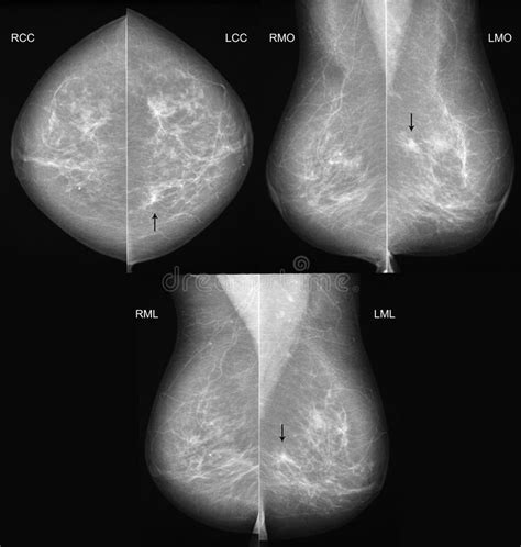 Breast Cancer Mammography In 3 Projections Stock Photo Image Of