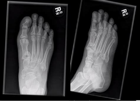 Metatarsal Fractures Foot And Ankle Orthobullets