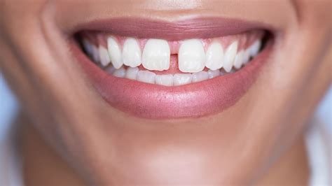 How To Cover Up A Gap In Your Teeth Teethwalls