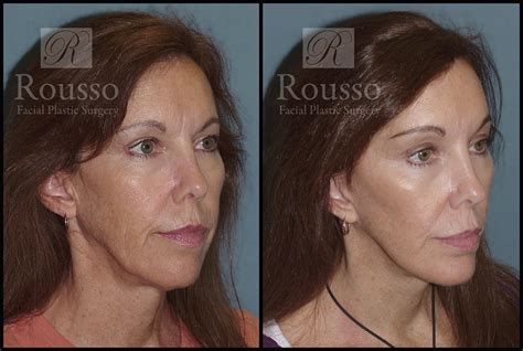 Patient 3262152 Mini Lift Before And After Rousso Facial Plastic Surgery