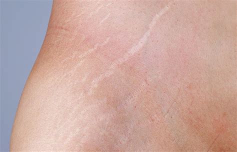 How To Get Rid Of White Stretch Marks