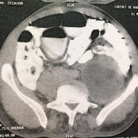 Transverse Ct Scan Showing The Hydatid Cyst Of The Psoas Download