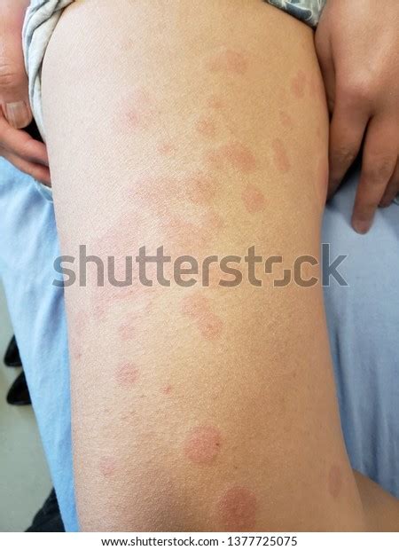 Urticaria Hives Food Allergy Red Rashes Stock Photo Edit Now 1377725075