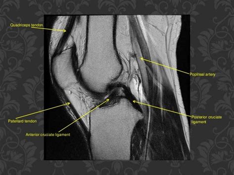 Mri Knee Of Orthopedic Importance