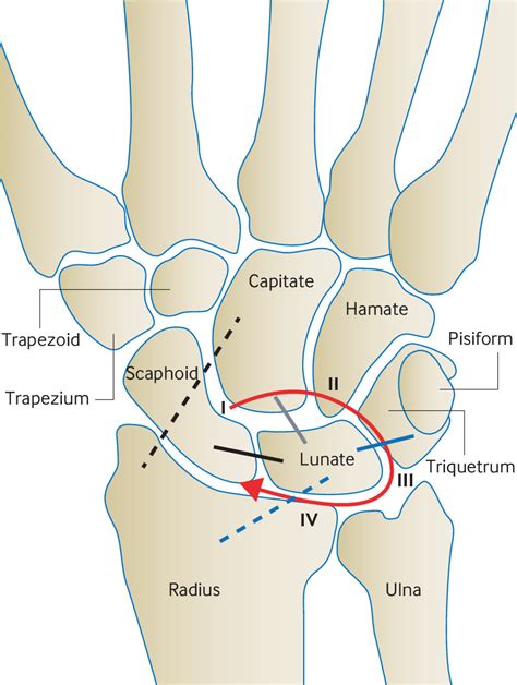 A Wrist Injury The Bmj