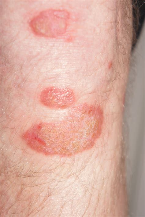 Identifying 21 Common Red Spots On Skin Universal Dermatology