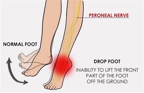 Neurological Conditions Foot Drop The Body Rehab