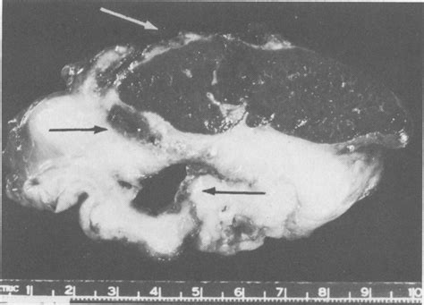 Intrasplenic Dissection By Pancreatic Pseudocysts Nejm