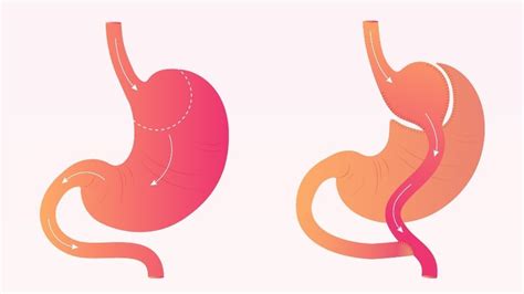 How Long Does Gastric Bypass Surgery Take Recovery Timeline For Surgery