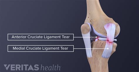 Medial Collateral Ligament Mcl Tears And Sprains
