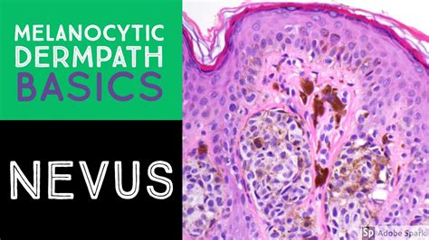 Melanocytic Dermpath Basics Benign Nevus Youtube