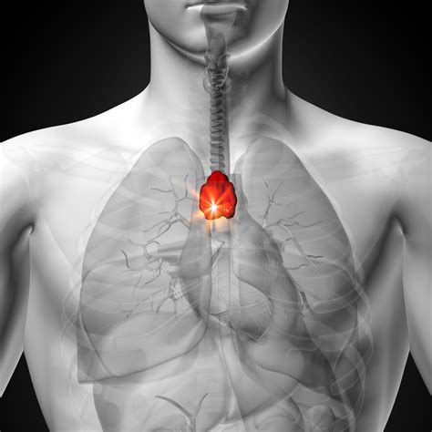 How To Treat Thymus Gland Disorders