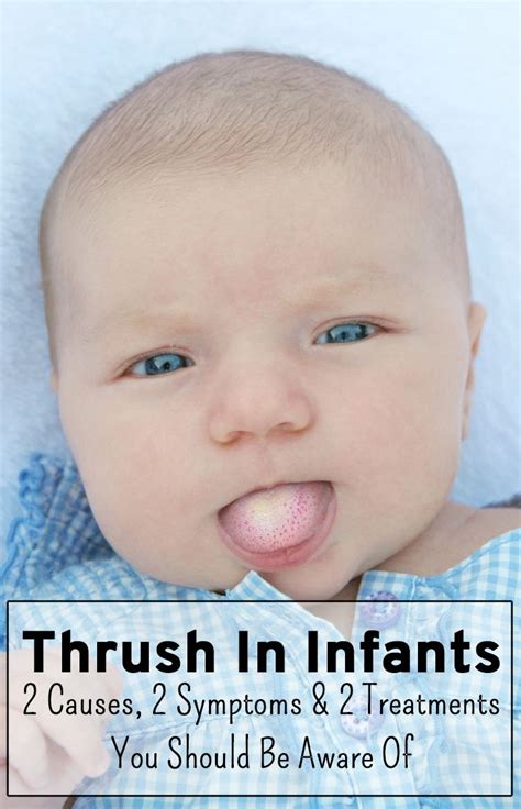 Pros And Cons Of White Coating On The Babys Tongue Oral Thrush Baby
