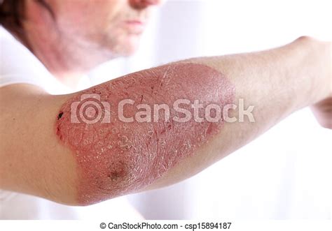 Person With Plaque Psoriasis Of The Arm Causing An Inflamed Red Patch