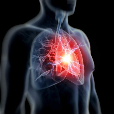 Dapagliflozin Approved To Reduce Cv Death Heart Failure