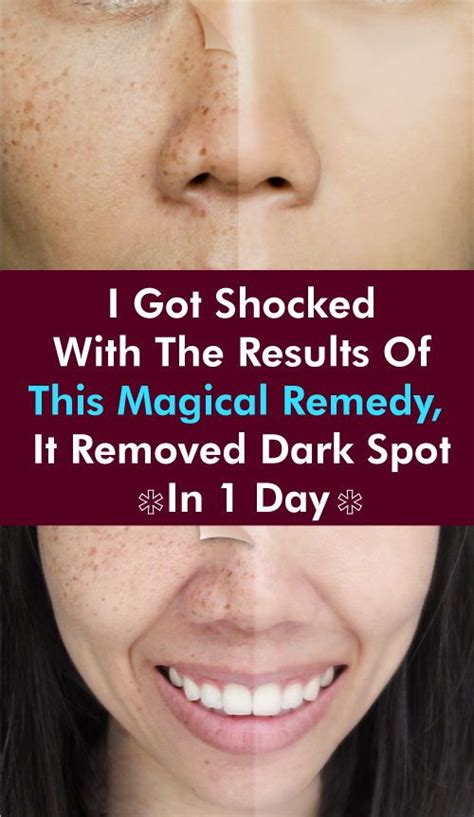 this 2 ingredient remedy removes all spots from your face in just 3 nights as people get older