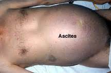 Ascites is a major complication of cirrhosis, 1 occurring in 50% of patients over 10 years of follow up. CH23 Clinical Terms I