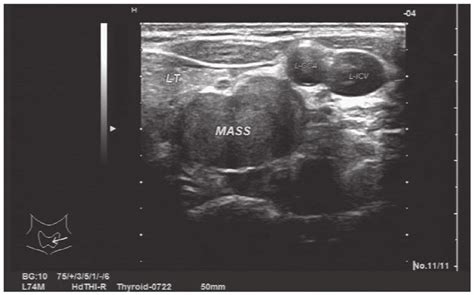 Ultrasonography Revealed Multiple Bilateral Thyroid Nodules And A