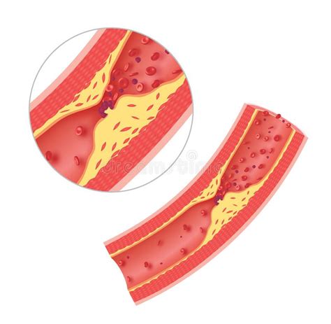 Atherosclerosis In Artery Athersclerosis In Artery Caused By