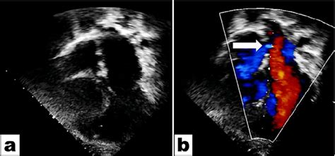 Ultrasound From Apical 4 Chambers View Hypoplastic Rv And Asd A