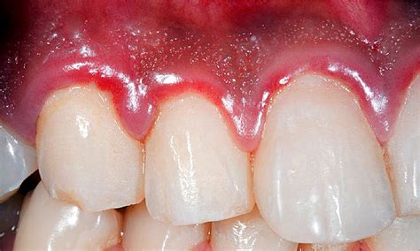 Why Are People With Severe Gum Disease More At Risk Of Diabetes Heart