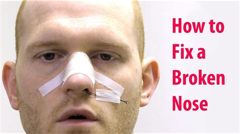 How To Fix A Broken Nose Without Sedation Closed Nasal Reduction