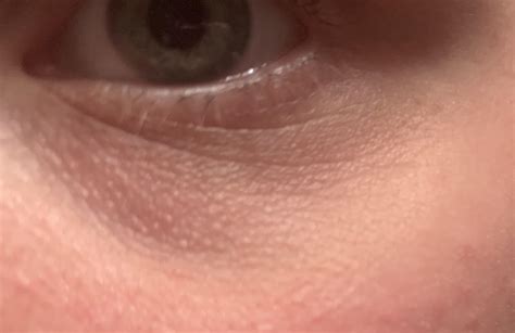 Advice On How To Get Rid Of These Little Bumps Under Eyes And Help Dark