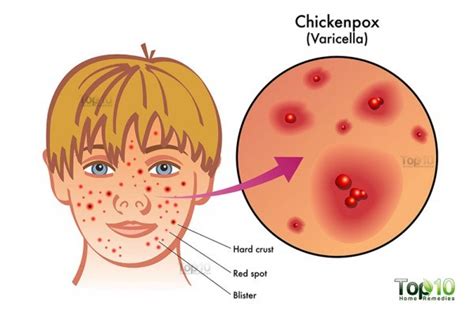 Home Remedies For Chickenpox Top 10 Home Remedies