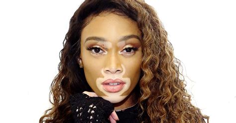 What Is Vitiligo Celebrity Model Photos April Star