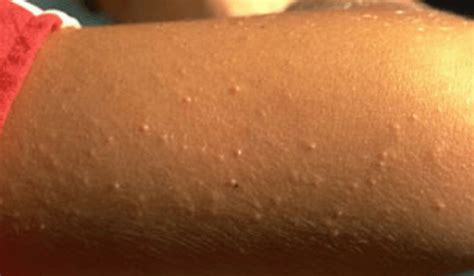 Itchy Bumps On Arms