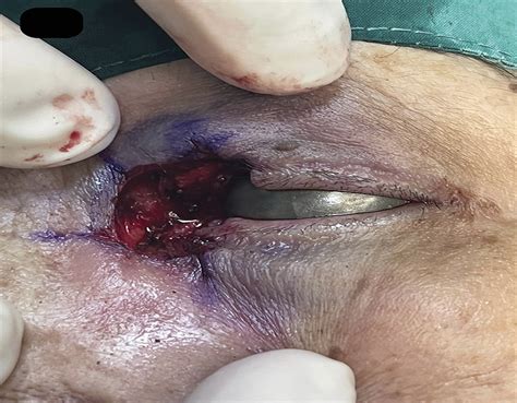 Reconstruction Of A Medial Eyelid Defect Following Mohs Surg