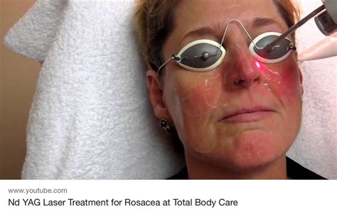 Rosacea Laser Therapy 2 Treatments Columbia Laser And Aesthetics Center