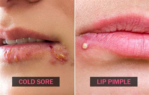 Cold Sores Vs Pimples How They Look Causes And Treatment