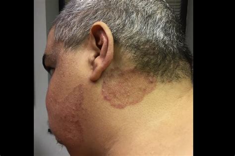 Derm Dx A Moderately Itchy Rash On The Neck And Cheek Clinical Advisor
