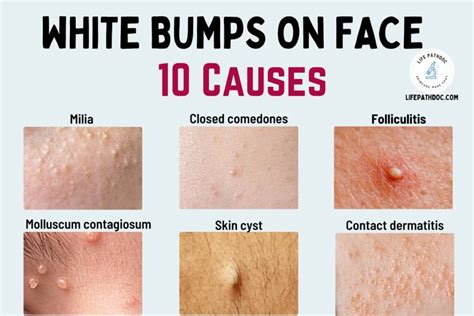 White Bumps On Face Milia And Other Causes