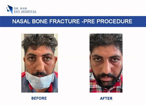 Fracture Nasal Bone Treatment Treatment Of Nasal Fracture Ropar