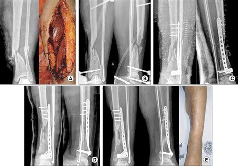 Fracture Of Tibia Tibial Stress Fracture Image