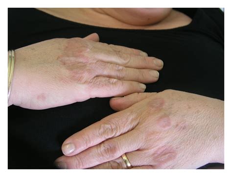 Figure 1 Granuloma Annulare Autoimmune Thyroiditis And Lichen