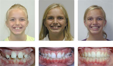 Braces Before And After Overjet