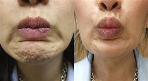 Wrinkle Treatment Before And After Botox Dermal Fillers