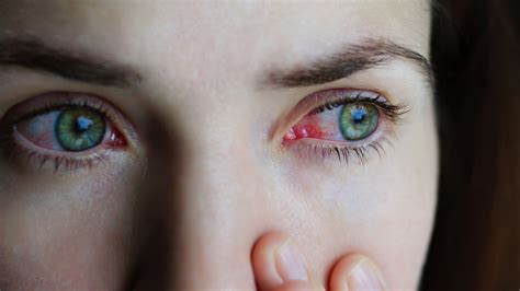 Conjunctivitis Symptoms Causes Diagnosis And Treatments
