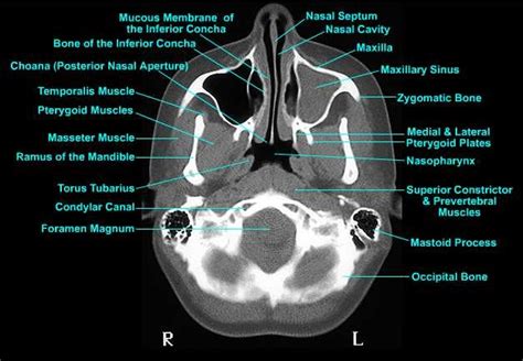 This means that the right side of the brain is on the left side of the viewer. Medical radiology imaging tips blog: Torus tubarius ct ...