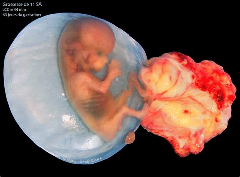 In humans, the fetal stage of prenatal development begins about seven or eight weeks after fertilization, when the major structures and organ systems have formed, until birth. Anatomie morphologique d'une grossesse de 11 SA - Images ...