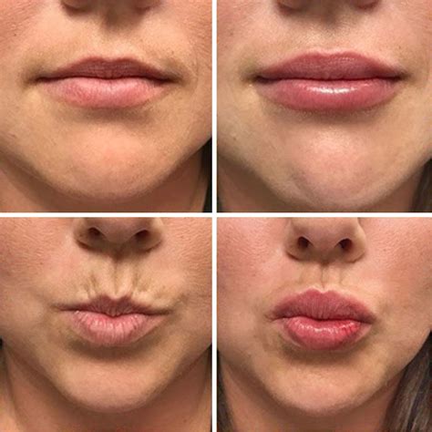 What Do Your Lips Look Like After Fillers